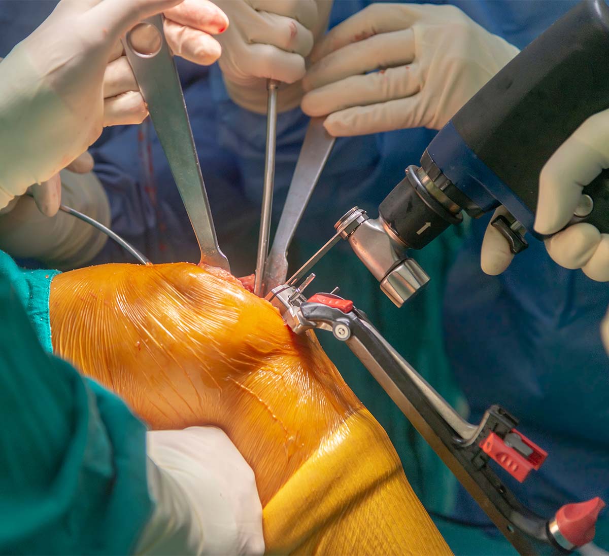 Knee surgery